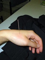 Acupuncture is physical stimulation which creates a cascade of positive changes inside the body.