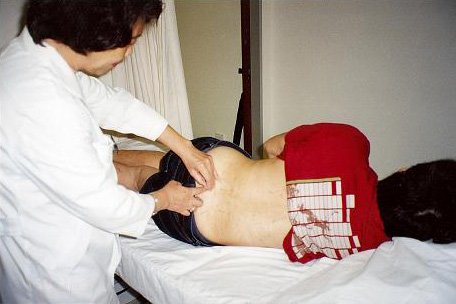 Acupuncture Treatment