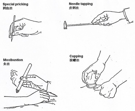 Additional Techniques in Chinese Acupuncture Treatments