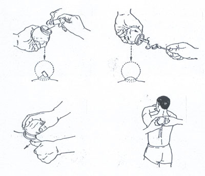 Cupping techniques 