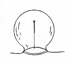 Cupping in combination with blood letting method 