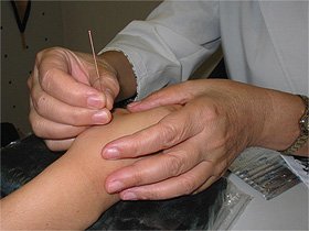 Needling on the acupoint: he gu (Li 4) 