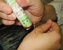 moxibustion