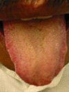 Tongue covered with yellow and greasy fur.