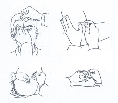 Different ways of needle insertions. 