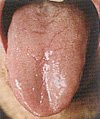 The tongue has a slimy covering when excess phlegm is present.