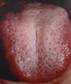 The tongue has a white and greasy coating.
