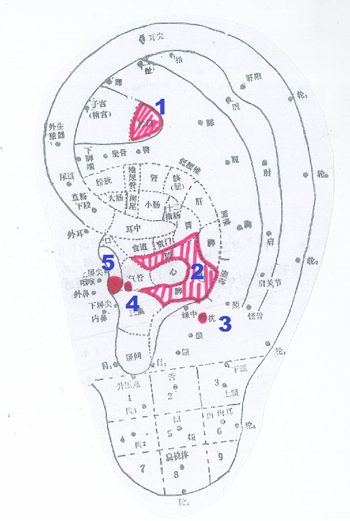 1. 神門 2. 肺 3. 枕 4. 內分泌 5. 腎上腺